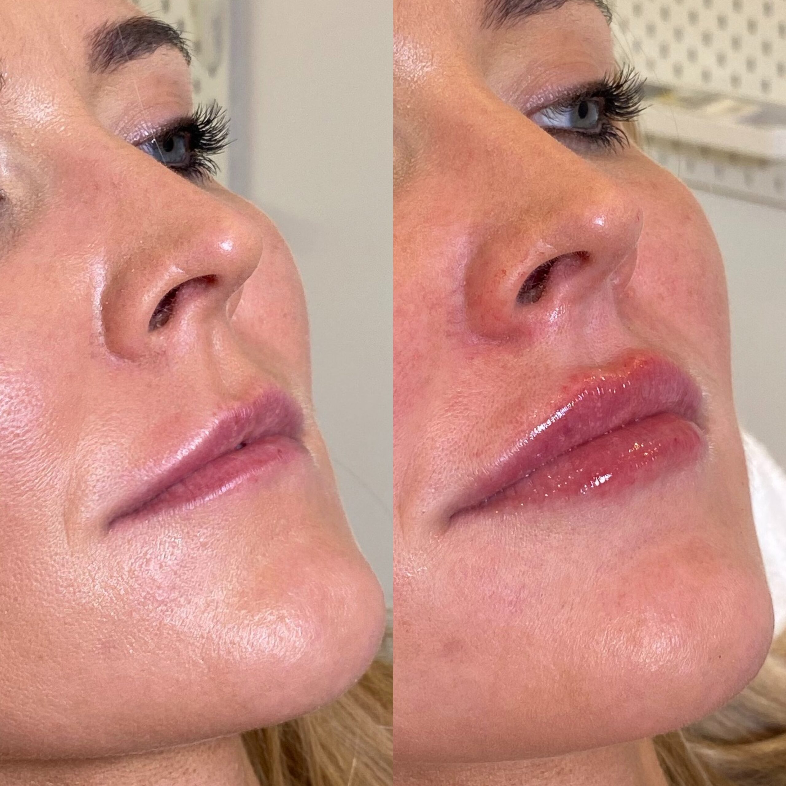 Rimpels wegwerken? Dat doe je zo: de 4 beste manieren | Sarasin Clinic